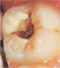 Кариозная полость в зубе  